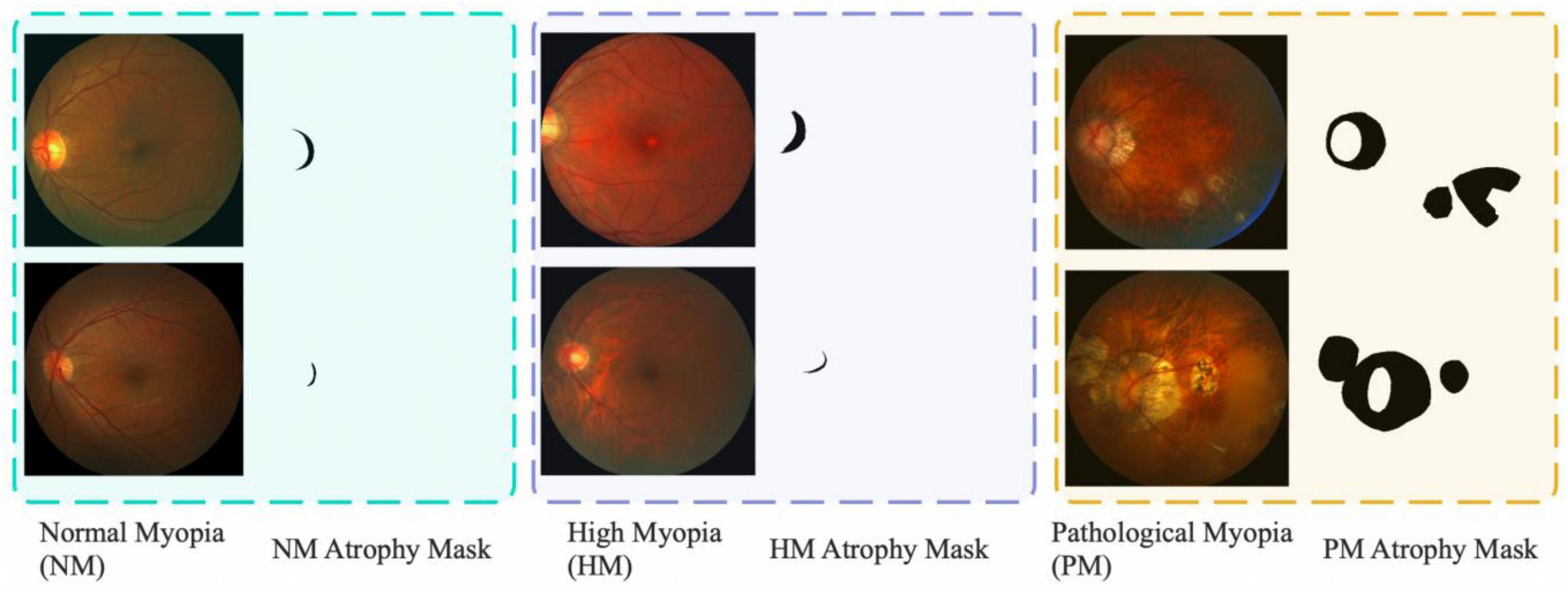 MyopiaDETR: End-to-end pathological myopia detection based on transformer using 2D fundus images